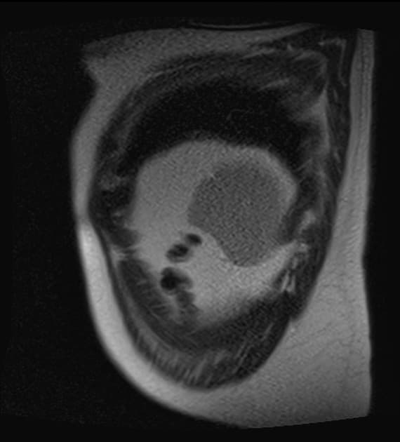 Hepatic adenoma (complicated by hemorrhage)