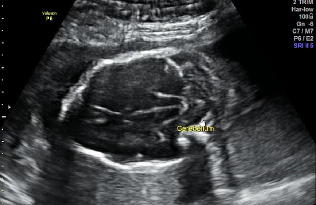 Chiari II Malformation in Fetal MRI (Bất thường Chiari-II)