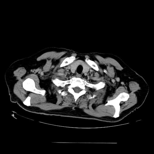 Fungal Pneumonia in an Immunocompromised Patient (Viêm phổi do nấm ở bệnh nhân suy giảm miễn dịch)