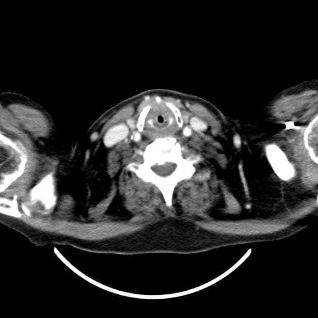 Esophageal Squamous Cell Carcinoma (Ung thư thực quản)