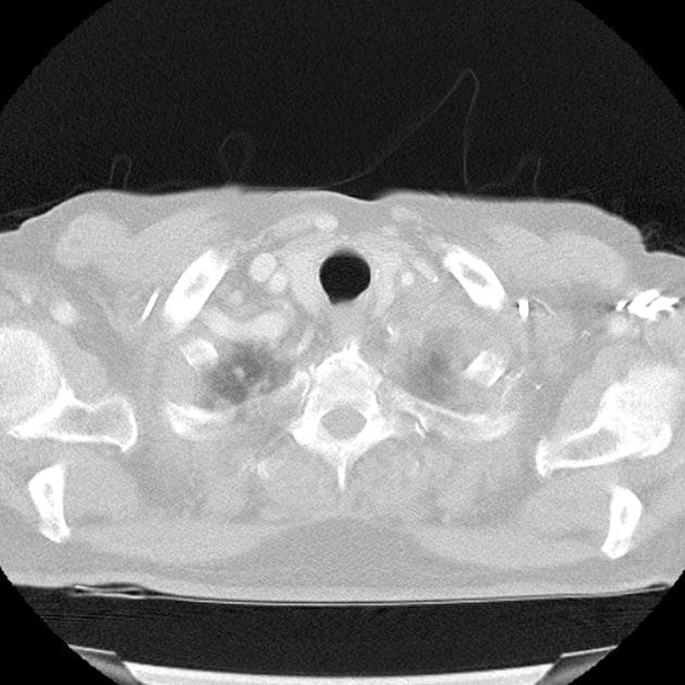 Metastatic Esophageal Carcinoma (Ung thư thực quản di căn)