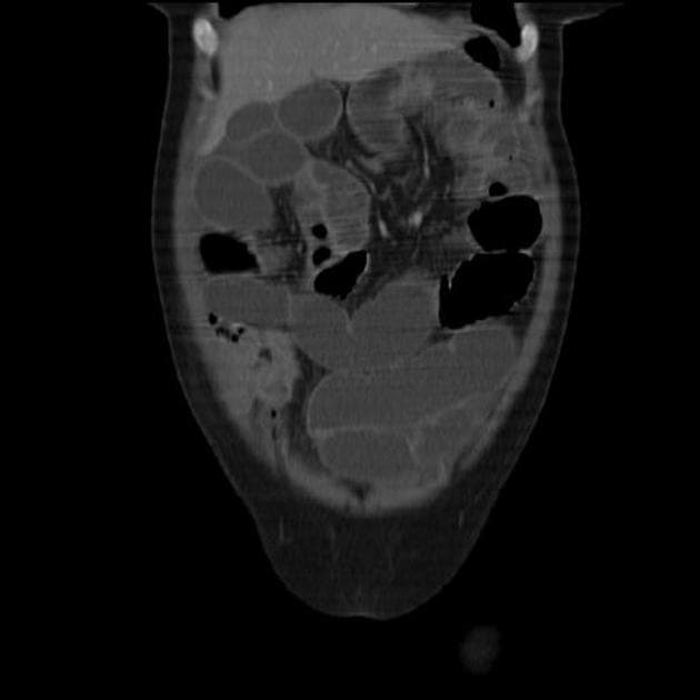 Ileocecal tuberculosis with intestinal obstruction