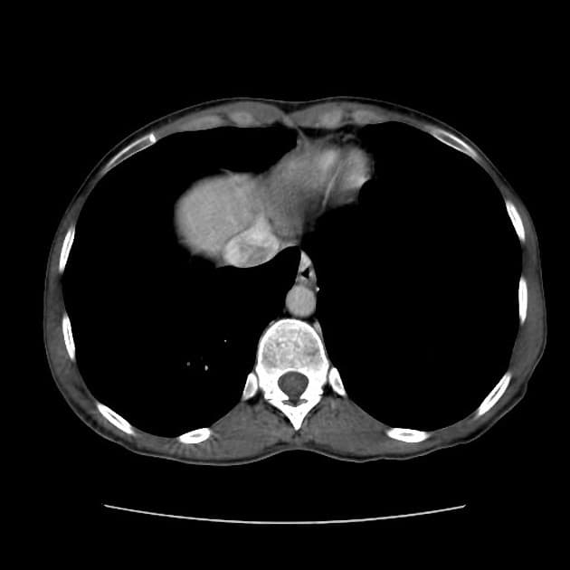 Inflammatory hepatic adenoma