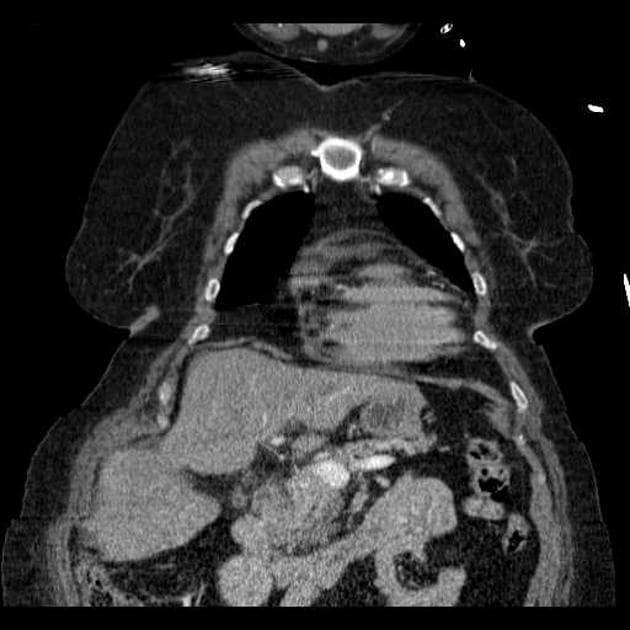 Extensive aortic dissection extending to renal arteries and involving arch branches