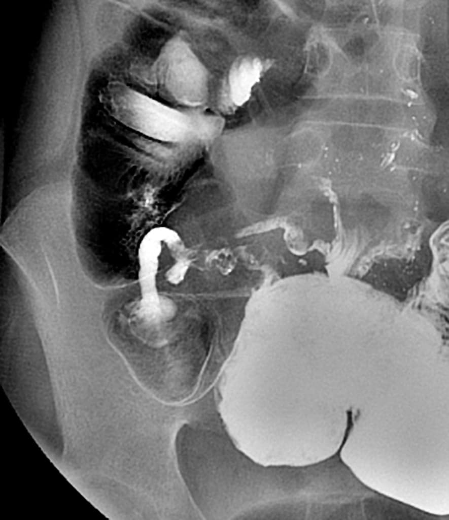 Gastrointestinal tuberculosis
