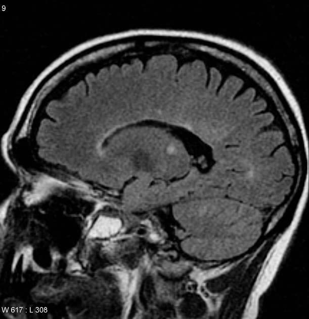 Multiple Sclerosis with T1 Hyperintense Lesions (Xơ cứng rải rác)