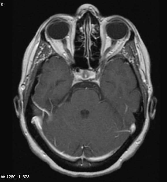 Papillary craniopharyngioma