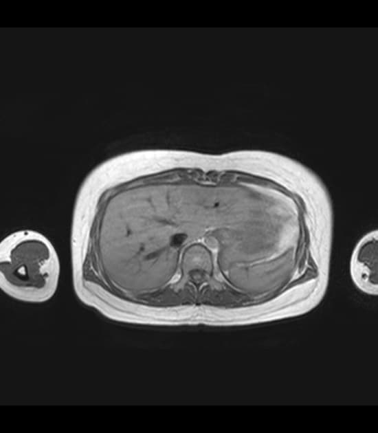 Hypertrophic cardiomyopathy with cor triatriatum