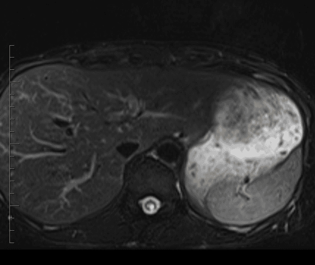 Von Hippel-Lindau Syndrome - Renal Manifestations (Hội chứng Von Hippel-Lindau - biểu hiện tại thận)