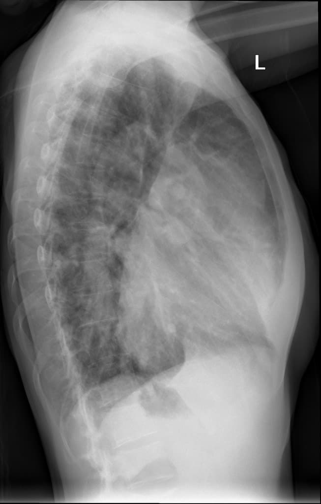 Patent ductus arteriosus
