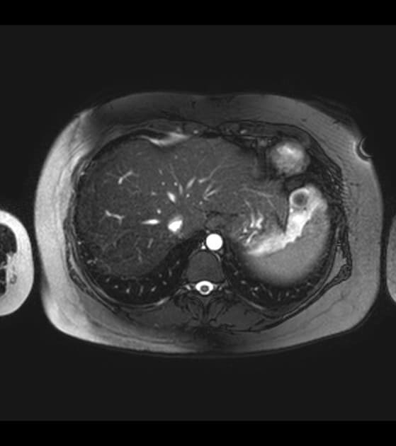 Hypertrophic cardiomyopathy