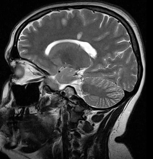 Multiple Sclerosis (Xơ cứng rải rác)