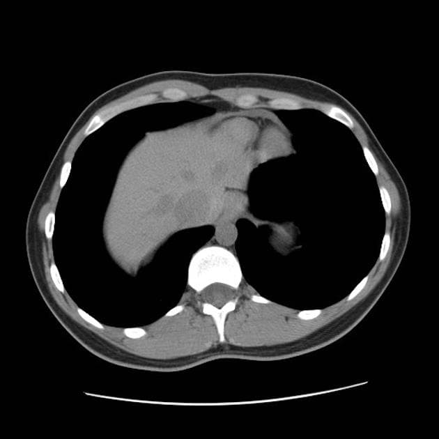 Von Hippel-Lindau Disease with Pancreatic Cysts and Renal Angiomyolipomas (Bệnh Von Hippel-Lindau (vHL))