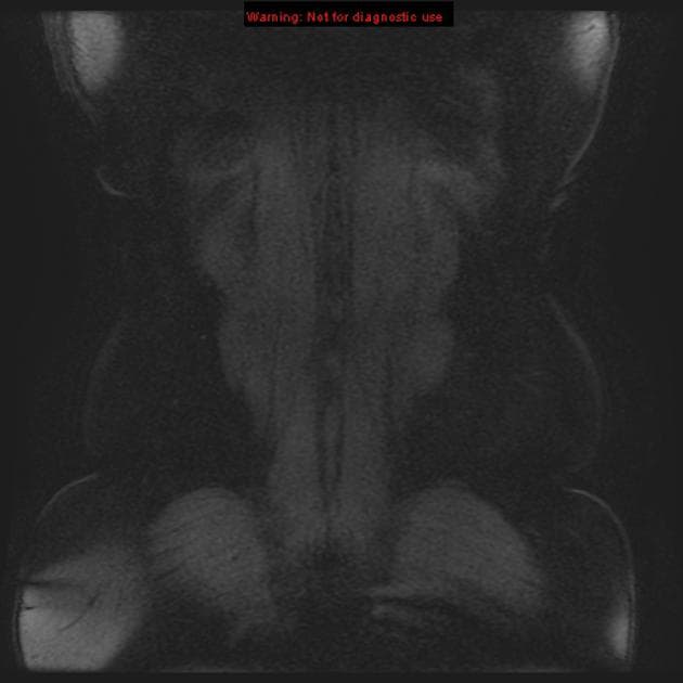 Transitional Cell Carcinoma of the Renal Pelvis (Ung thư tế bào chuyển tiếp ở bể thận)