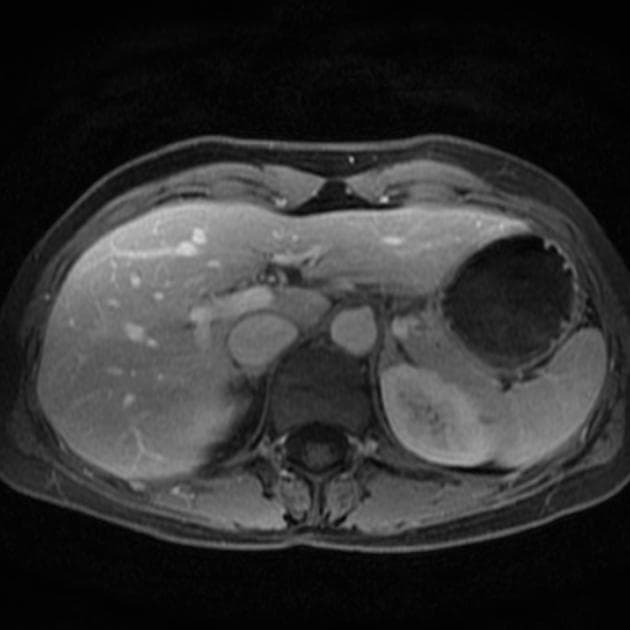 Focal Nodular Hyperplasia of the Liver (Tăng sản tuyến foca)