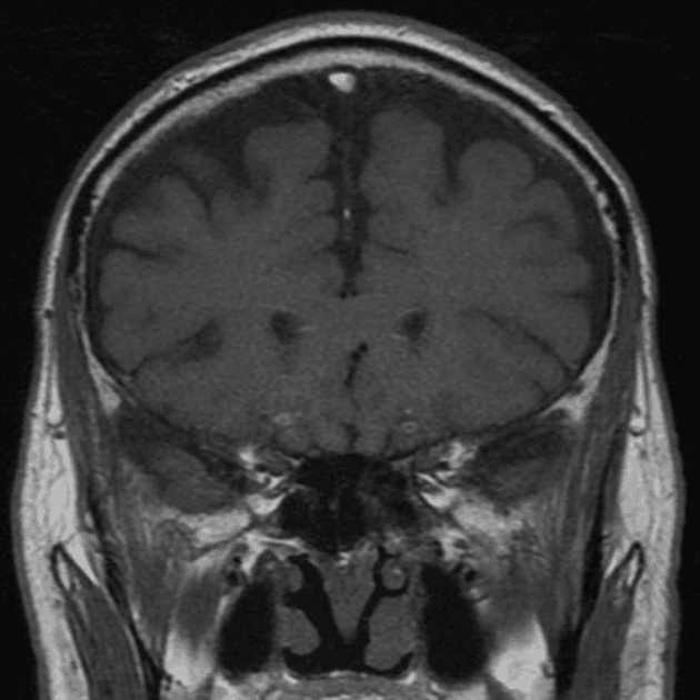Papillary craniopharyngioma