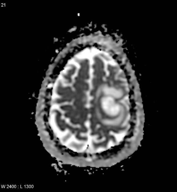 Ring-Enhancing Cerebral Metastasis (Khối u thứ phát ở não bắt thuốc dạng viền (ring-enhancing cerebral metastasis))