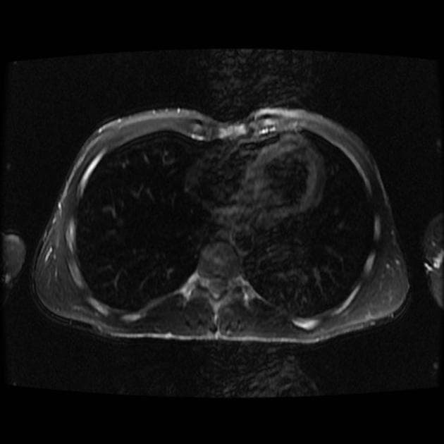 Focal Nodular Hyperplasia of the Liver (Tăng sản dạng nốt khu trú)
