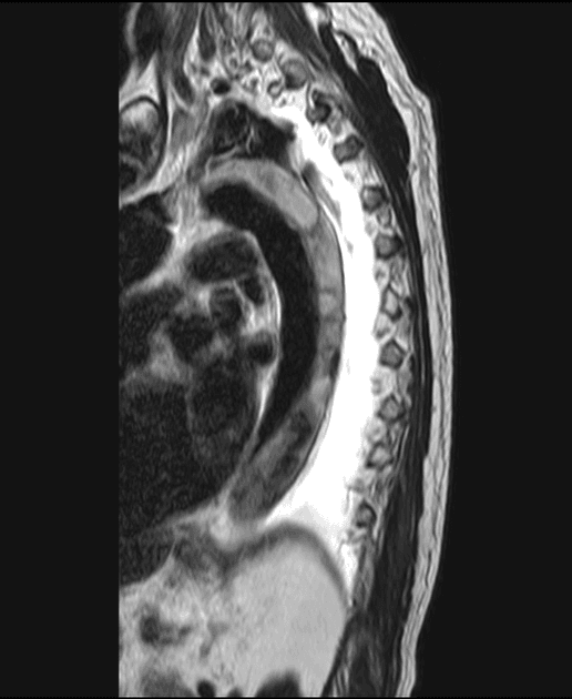 Spinal cord ischaemia