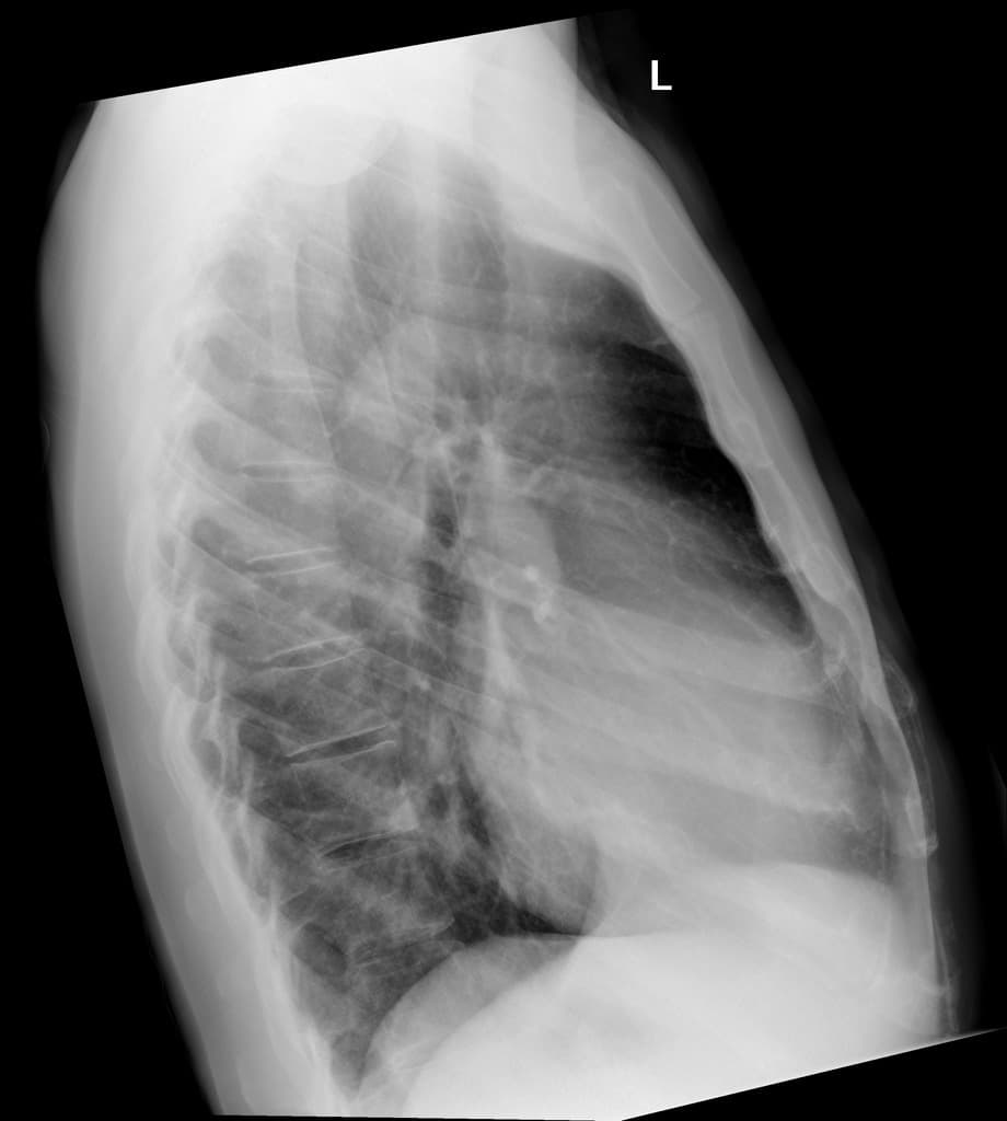 Cardiac Tumor - Undifferentiated Pleomorphic Sarcoma (Ung thư tim - sarcoma đa hình không biệt hóa)