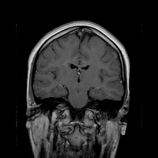 Multiple Sclerosis with Dissemination in Space and Time on MRI (Xơ cứng rải rác)