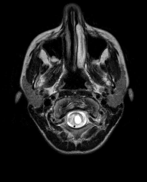 Von Hippel-Lindau Disease with Spinal Hemangioblastomas and Renal Cell Carcinoma (Bệnh Von Hippel-Lindau)