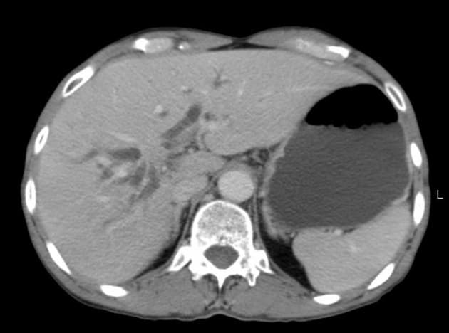 Klatskin Tumor (U Klatskin)