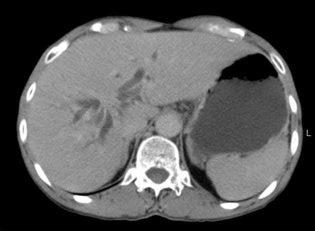 Klatskin Tumor (U Klatskin)