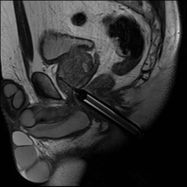 Prostate cancer - PI-RADS 3 apical nodule