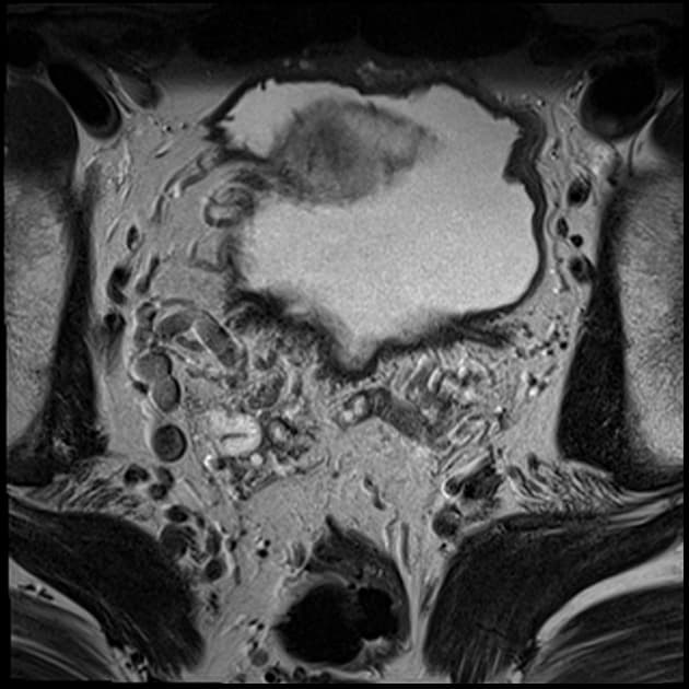 Prostate adenocarcinoma: anterior tumor on MRI (PI-RADS 5)