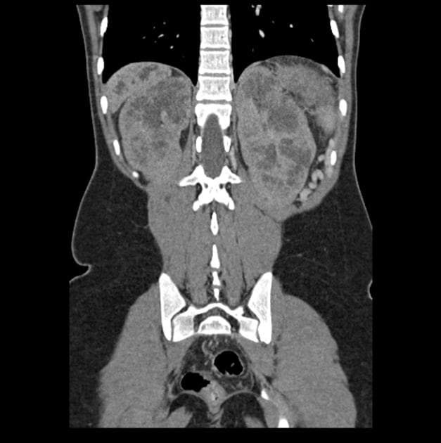 Caroli Syndrome and Autosomal Recessive Polycystic Kidney Disease (Hội chứng Caroli và bệnh thận đa nang thể khu trú nhiễm sắc thể thường lặn)