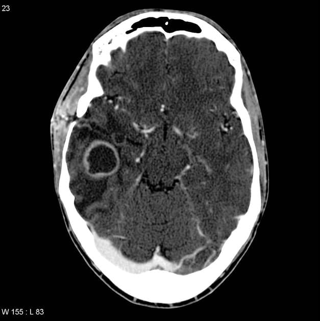 Cerebral Abscess with Surrounding Vasogenic Edema (Áp xe não)