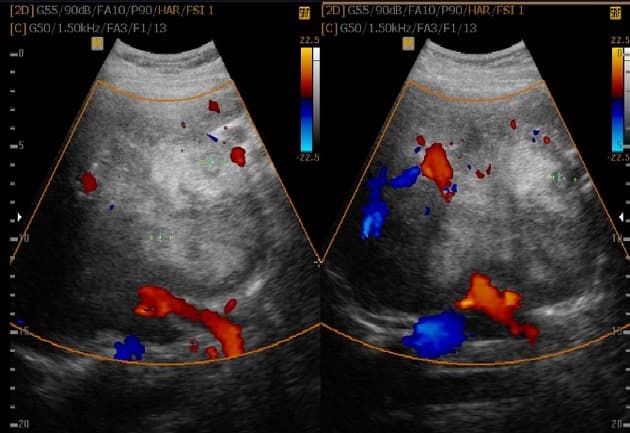 Hepatic adenoma