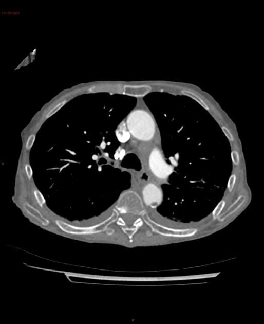 Atrial myxoma