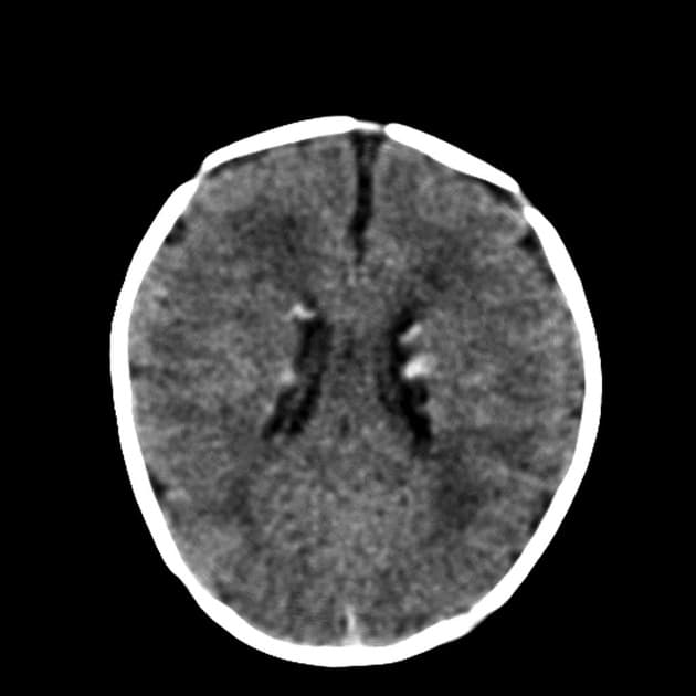 Tuberous Sclerosis with Cardiac Rhabdomyomas (Xơ cứng tuber và u cơ vân tim)