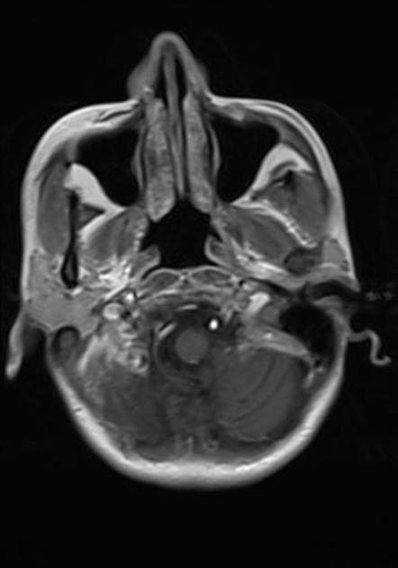 Cerebral Abscess in a Patient with Sickle Cell Anemia (Áp xe não)