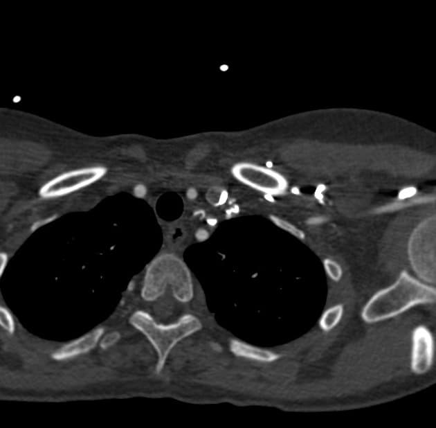 Tricuspid Atresia with Ventricular Septal Defect Status Post Fontan Procedure (Không có van ba lá)
