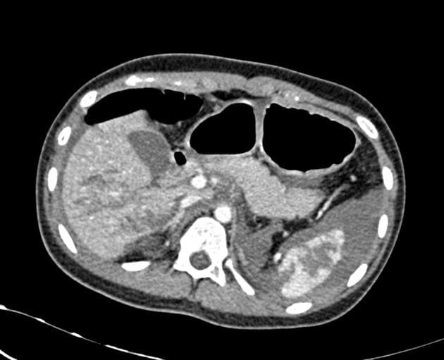 Multiorgan Trauma with Grade V Renal Injury (Chấn thương đa cơ quan với tổn thương thận độ V)
