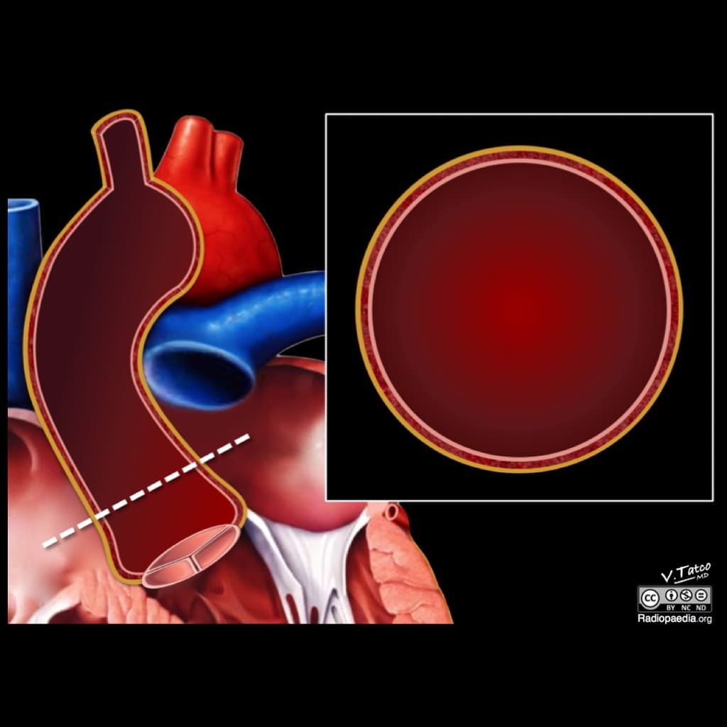 Pathogenesis of aortic dissection (illustration)