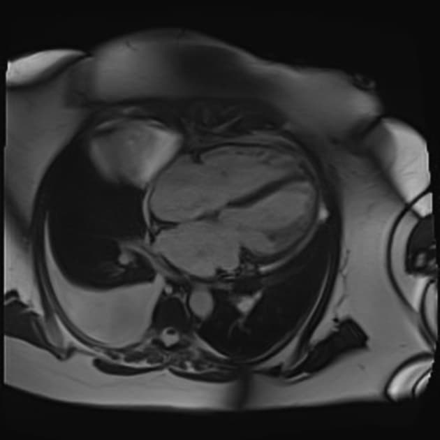 Lymphocytic myocarditis
