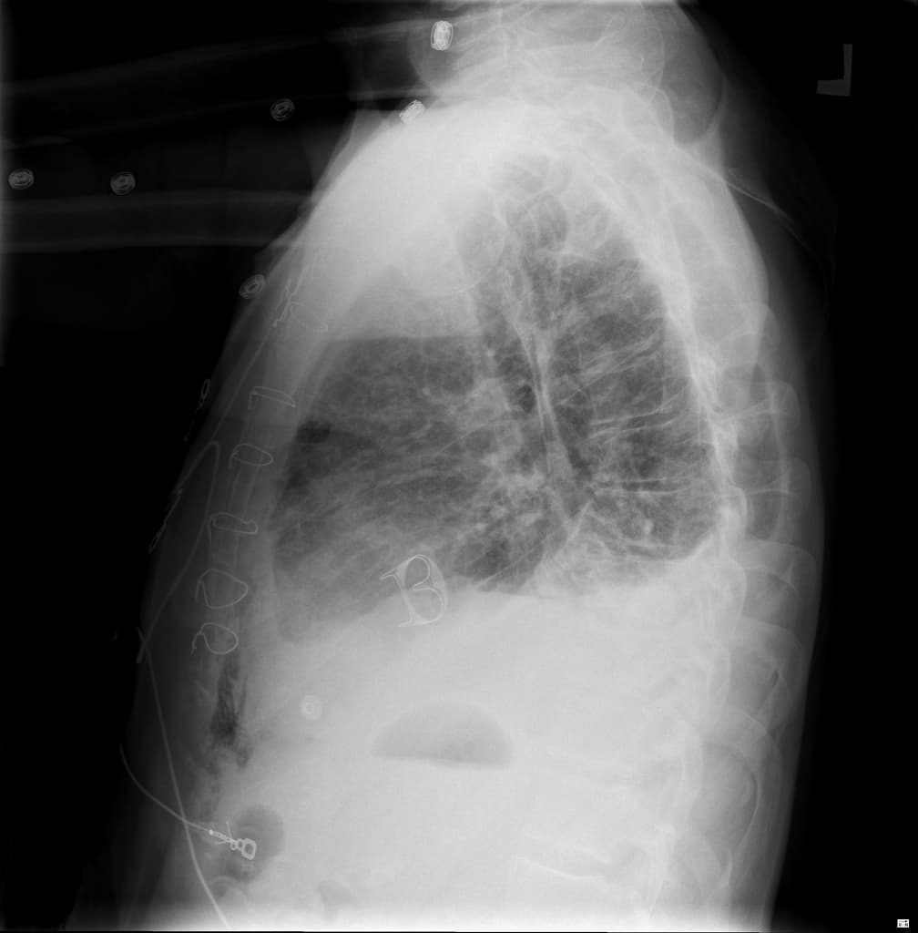 Unilateral pulmonary edema from acute mitral regurgitation