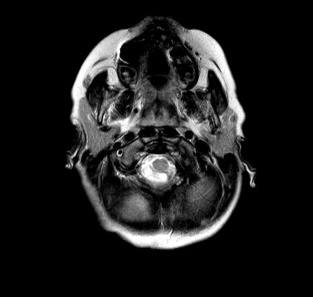 Lhermitte-Duclos disease
