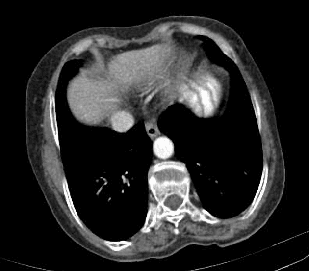 Cholangiocarcinoma (Ung thư tế bào gan đường mật)