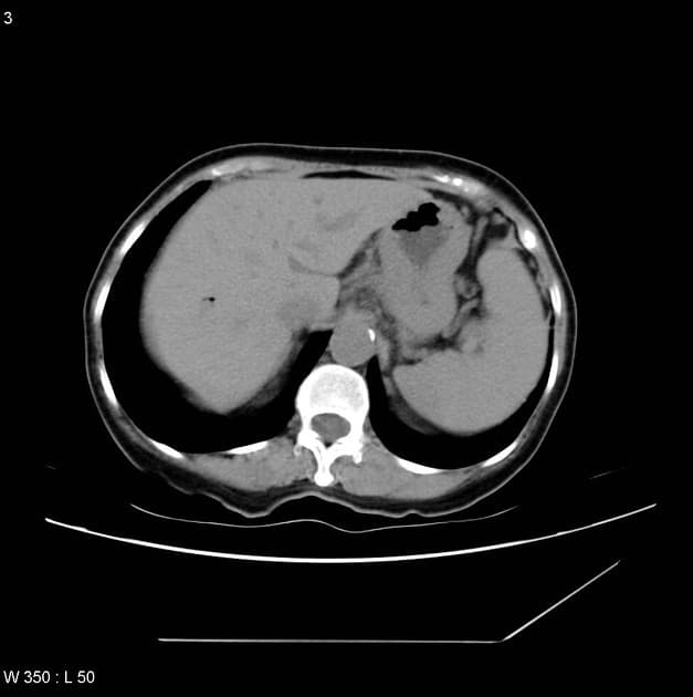 Pancreatic Cancer - Invasive Ductal Adenocarcinoma (Ung thư tụy - ung thư biểu mô tuyến ống xâm lấn)