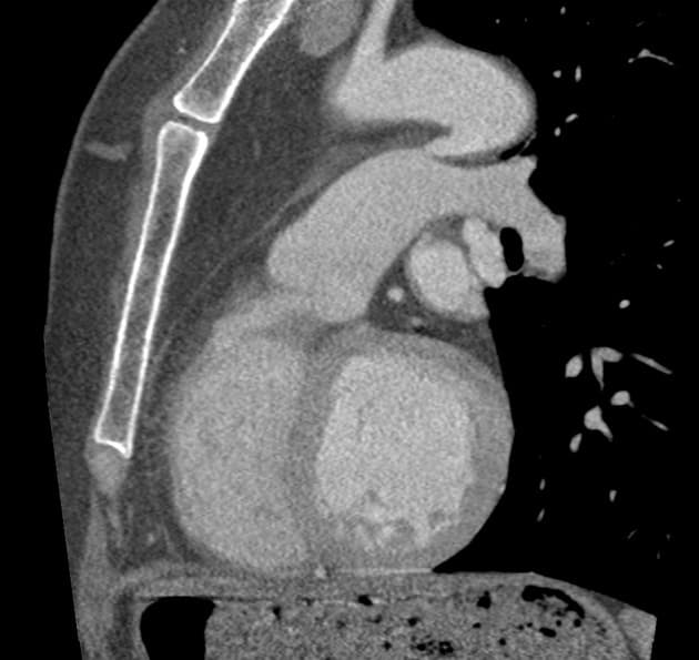 Patent ductus arteriosus