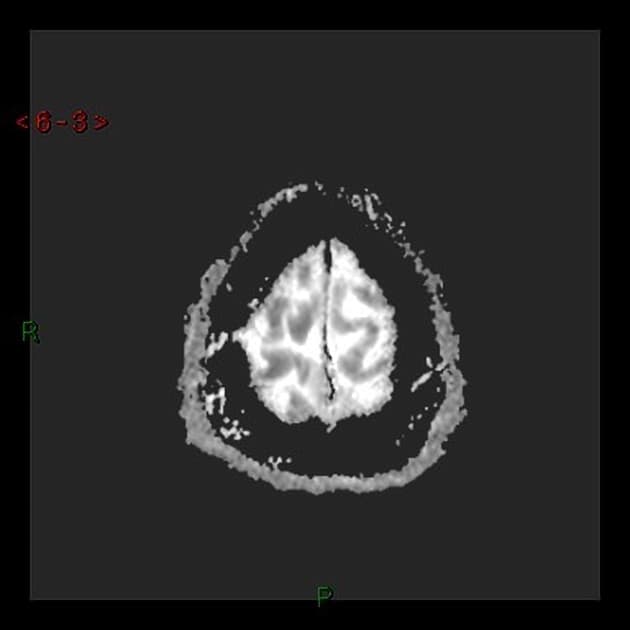 Acute Toxic Encephalopathy Due to 5-FU Chemotherapy (Bệnh não độc cấp tính)