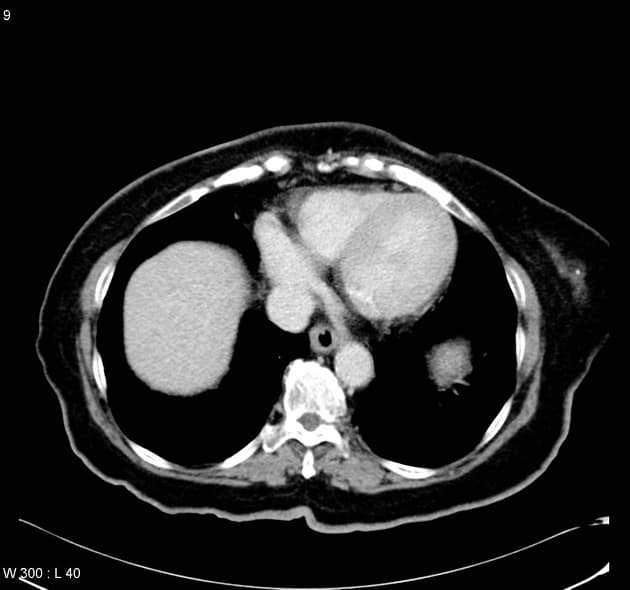 Pancreatic Tubular Adenoma (U tuyến ống tụy)