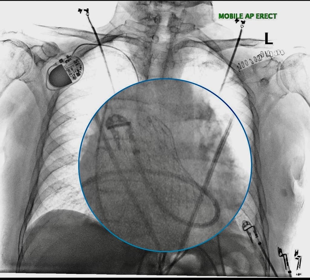 Transcatheter aortic valve implantation (TAVI)