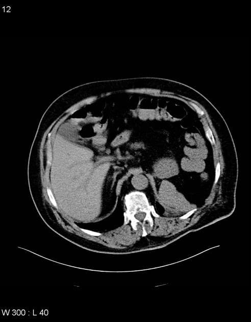 Pancreatic Metastasis from Renal Cell Carcinoma (Di căn tụy từ ung thư biểu mô tế bào thận)