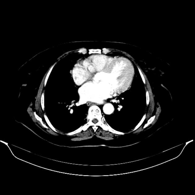 Intrahepatic Cholangiocarcinoma with Multisystem Metastases (Ung thư đường mật)